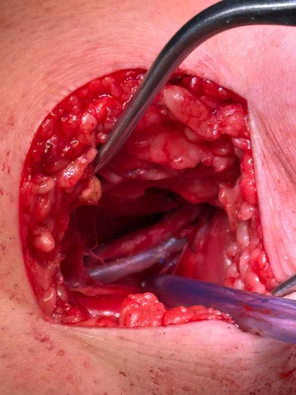 Vascular Trauma Repair